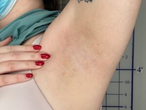 After Image: Laser Hair Reduction