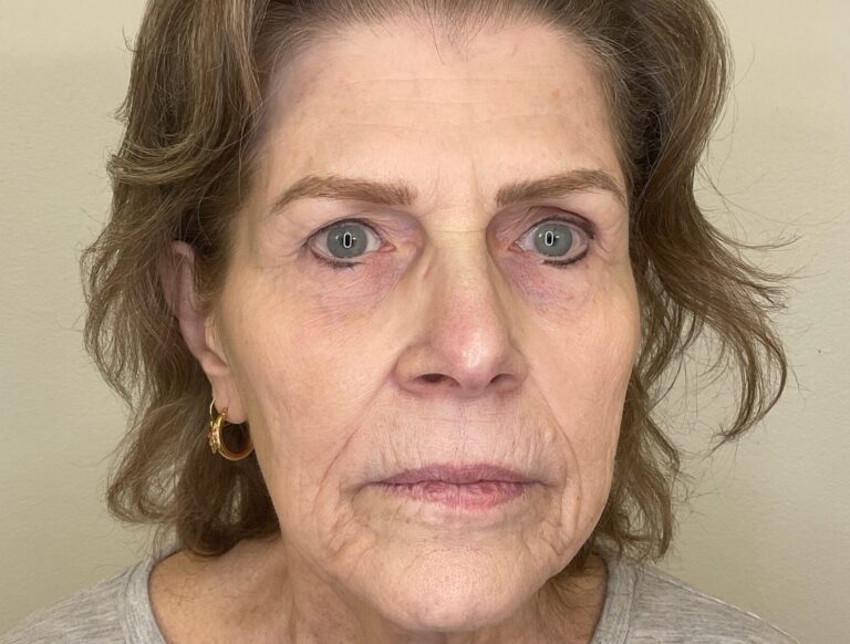 Before Image: Facial Fillers - front