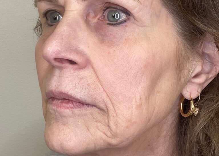 Before Image: Facial Fillers - left-front-oblique
