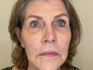 After Image: Facial Fillers