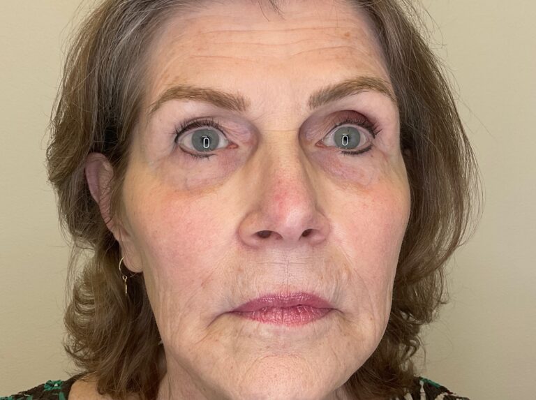 After Image: Facial Fillers - front