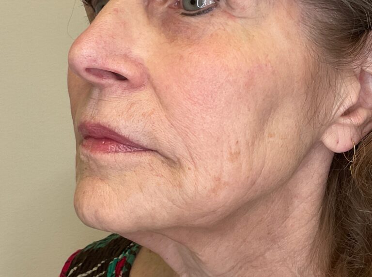 After Image: Facial Fillers - left-front-oblique
