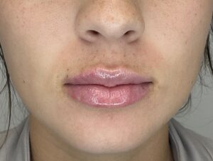 After Image: Lip Filler