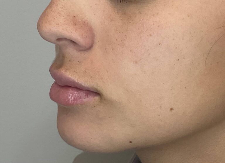 After Image: Lip Filler - left-front-oblique
