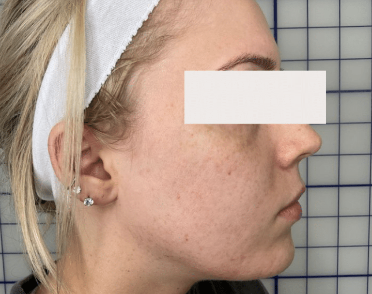 After Image: Erbium for Scarring - right-side