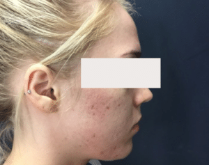 Before Image: Erbium for Scarring