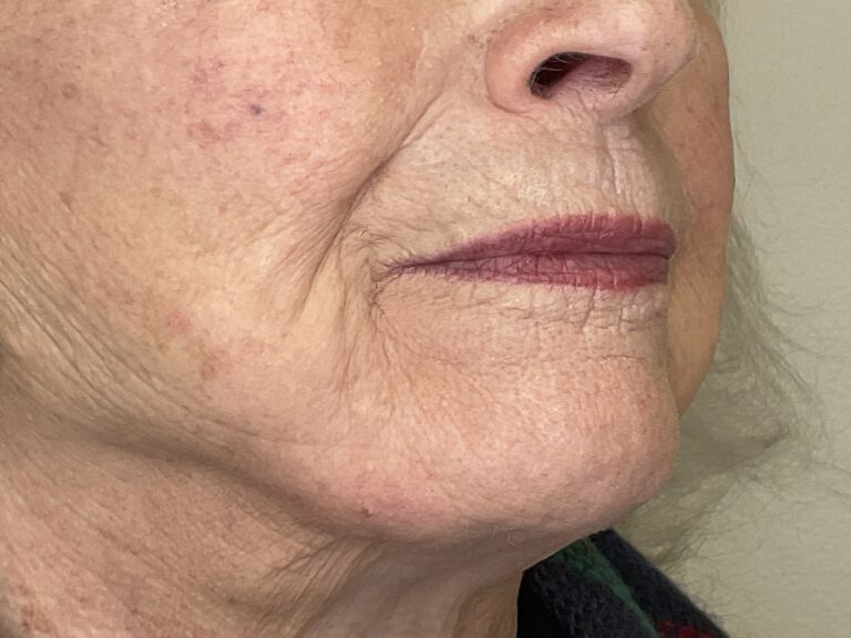 Before Image: Filler in Pucker Lines - right-front-oblique