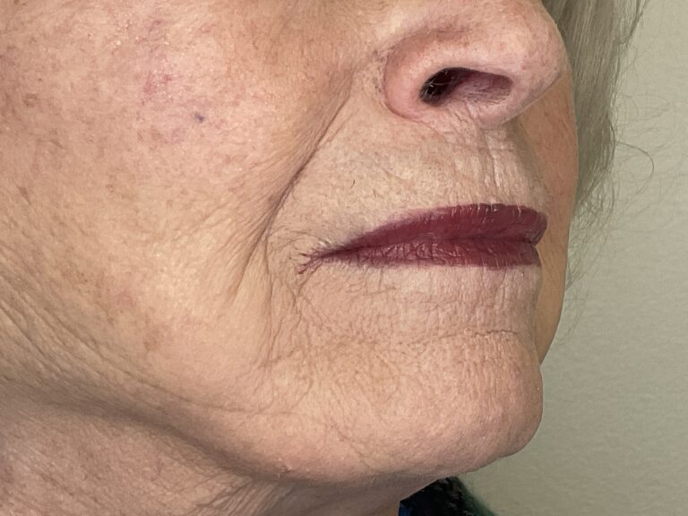 After Image: Filler in Pucker Lines - right-front-oblique