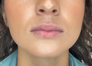 Before Image: Lip Filler