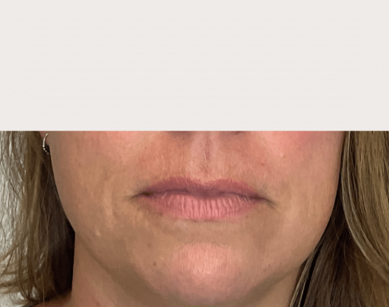 Before Image: Lip Filler - front