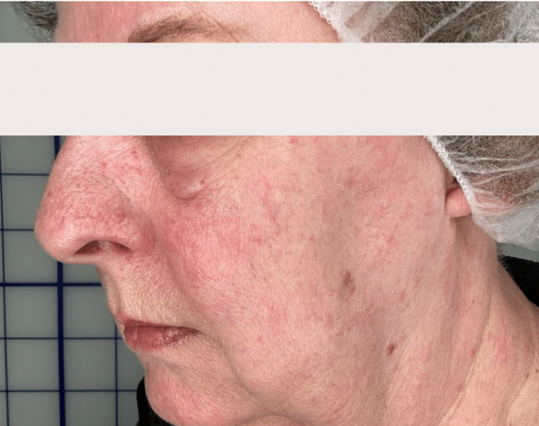 After Image: Laser Vein Removal (Yag) - left-front-oblique