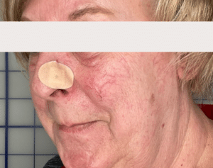 Before Image: Laser Vein Removal (Yag)