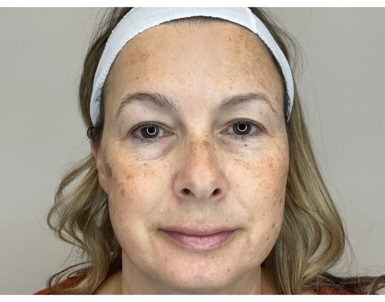 Before Image: Brown Spots & Sun Damage - front