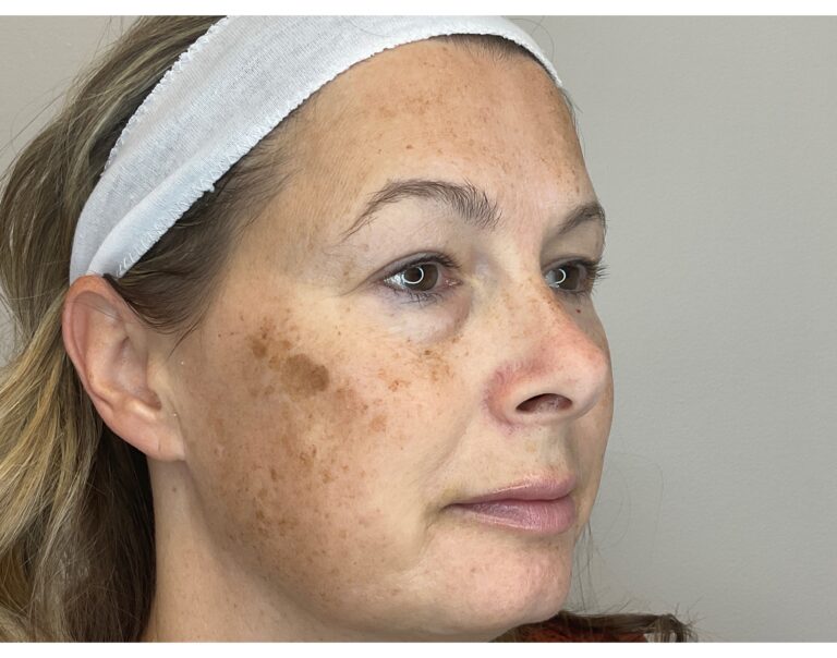 Before Image: Brown Spots & Sun Damage - front