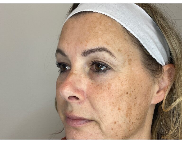 Before Image: Brown Spots & Sun Damage - front