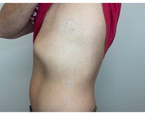 After Image: Tattoo Removal