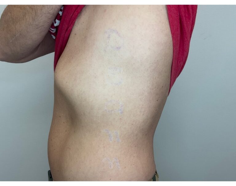 After Image: Tattoo Removal - left-side
