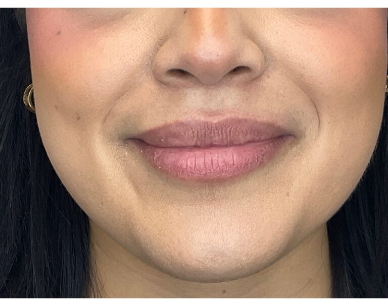 Before Image: Lip Filler - front