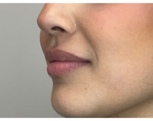 Before Image: Lip Filler