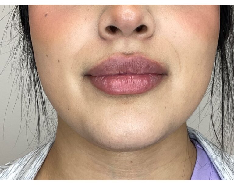 After Image: Lip Filler - front