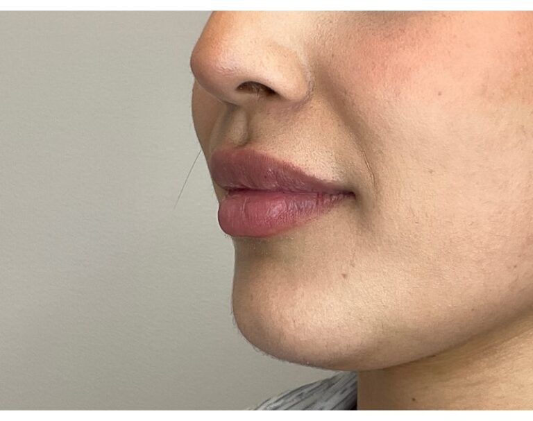 After Image: Lip Filler - left-front-oblique