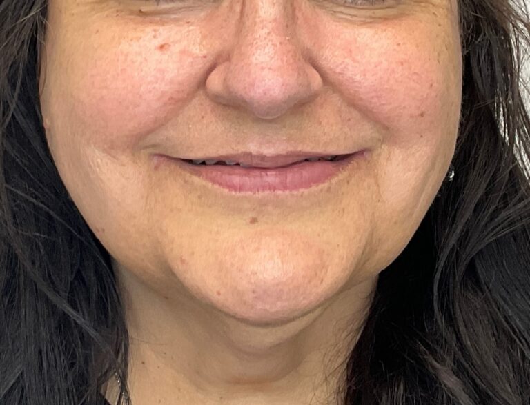 Before Image: Lip Filler - front