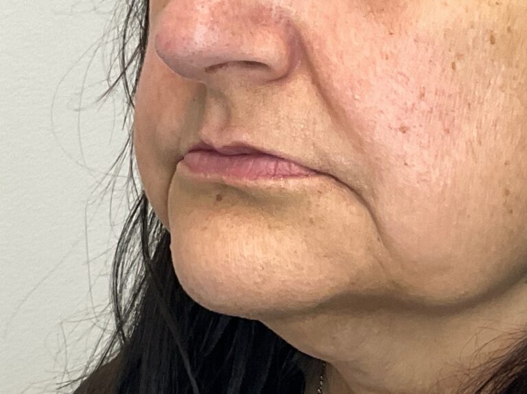 Before Image: Lip Filler - left-front-oblique