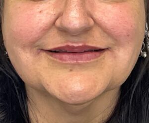 After Image: Lip Filler