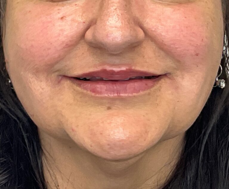 After Image: Lip Filler - front