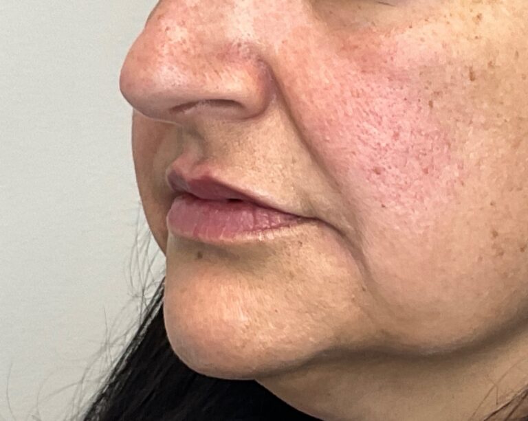 After Image: Lip Filler - left-front-oblique