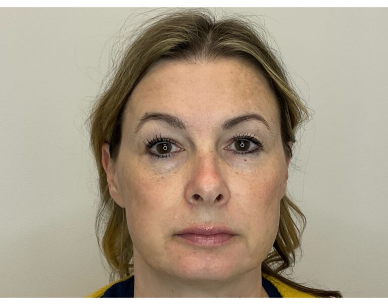 After Image: Brown Spots & Sun Damage - front