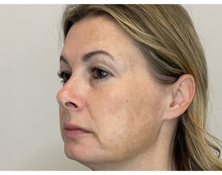 After Image: Brown Spots & Sun Damage - front