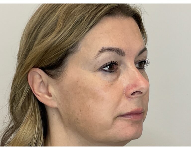 After Image: Brown Spots & Sun Damage - front