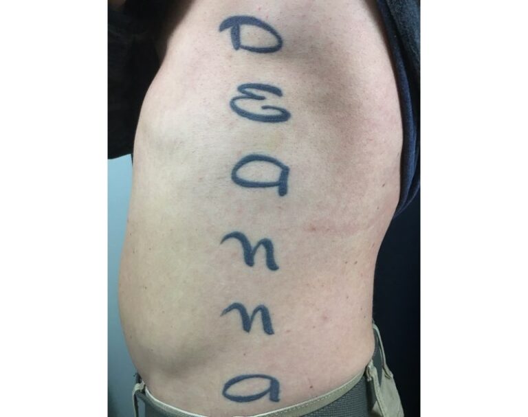 Before Image: Tattoo Removal - left-side