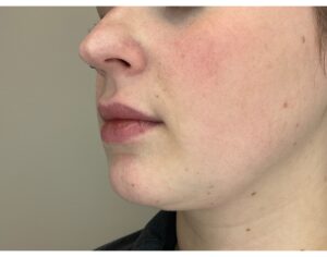 Before Image: Lip Filler
