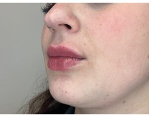 After Image: Lip Filler