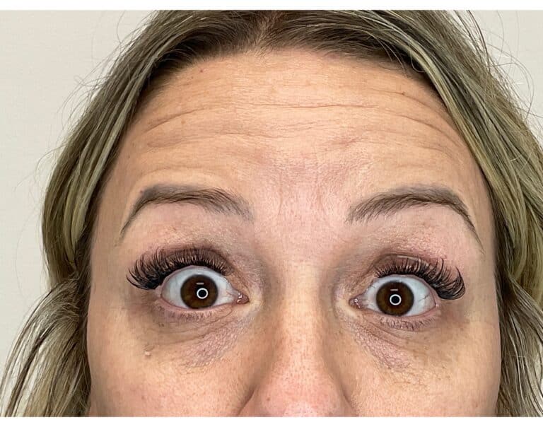 Before Image: Botox - front