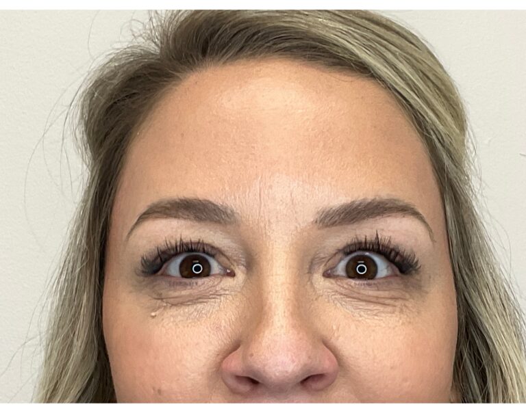 After Image: Botox - front