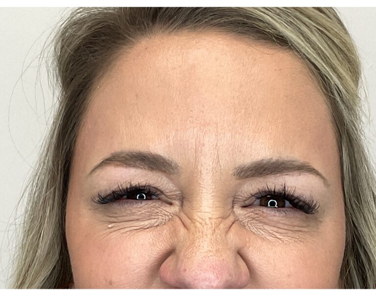 After Image: Botox - front