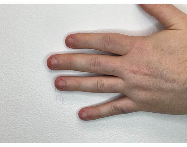 After Image: Tattoo Removal - front