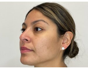 After Image: PicoSure, Diamond Glow & SkinMedica