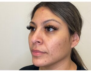 Before Image: PicoSure, Diamond Glow & SkinMedica
