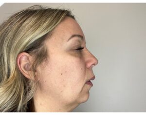 Before Image: Facial Fillers