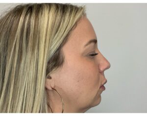 After Image: Facial Fillers
