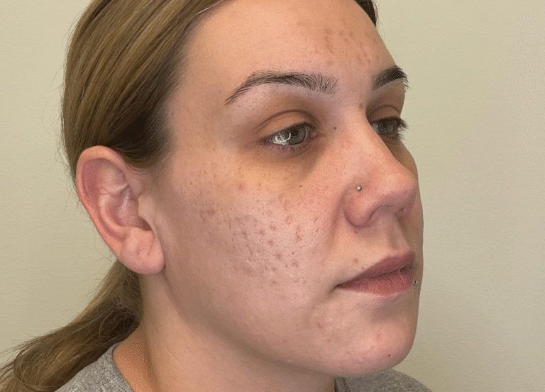 Before Image: Potenza RF Microneedling: Acne Scars - right-front-oblique