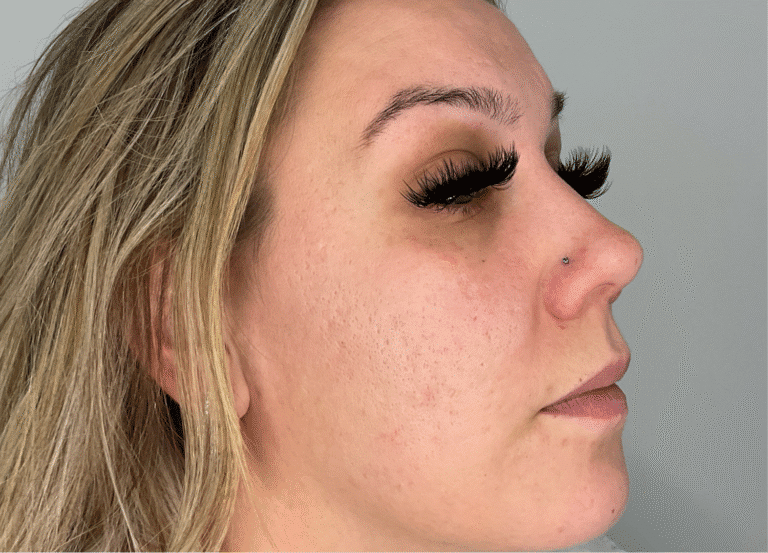 After Image: Potenza RF Microneedling: Acne Scars - right-front-oblique