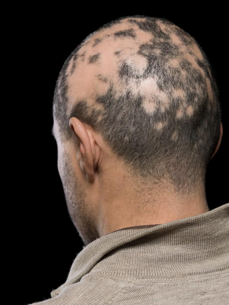 Rear view of mans head with alopecia