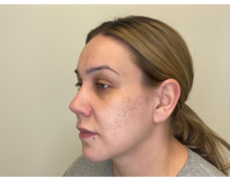 Before Image: Potenza RF Microneedling: Acne Scars - left-side