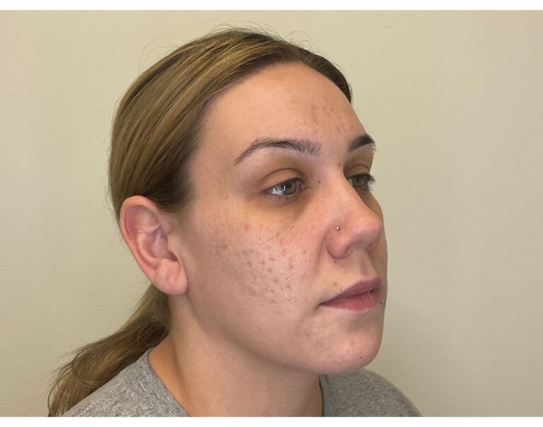 Before Image: Potenza RF Microneedling: Acne Scars - right-front-oblique