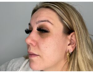 After Image: Potenza RF Microneedling: Acne Scars